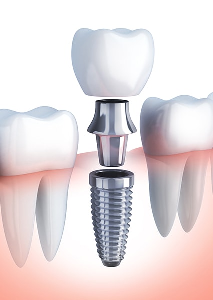 implant (1) implant (1)