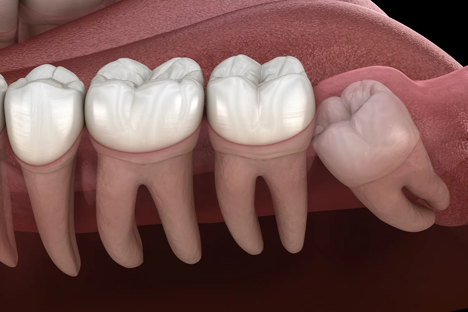 Wisdom teeth extraction illustration