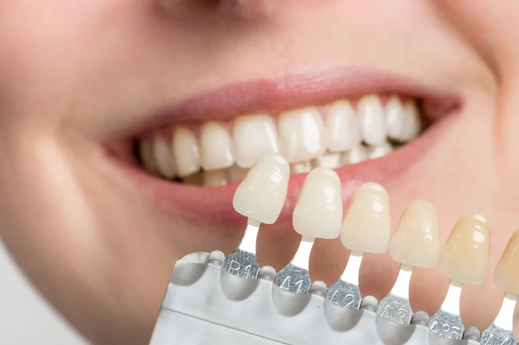 Dental veneers treatment
