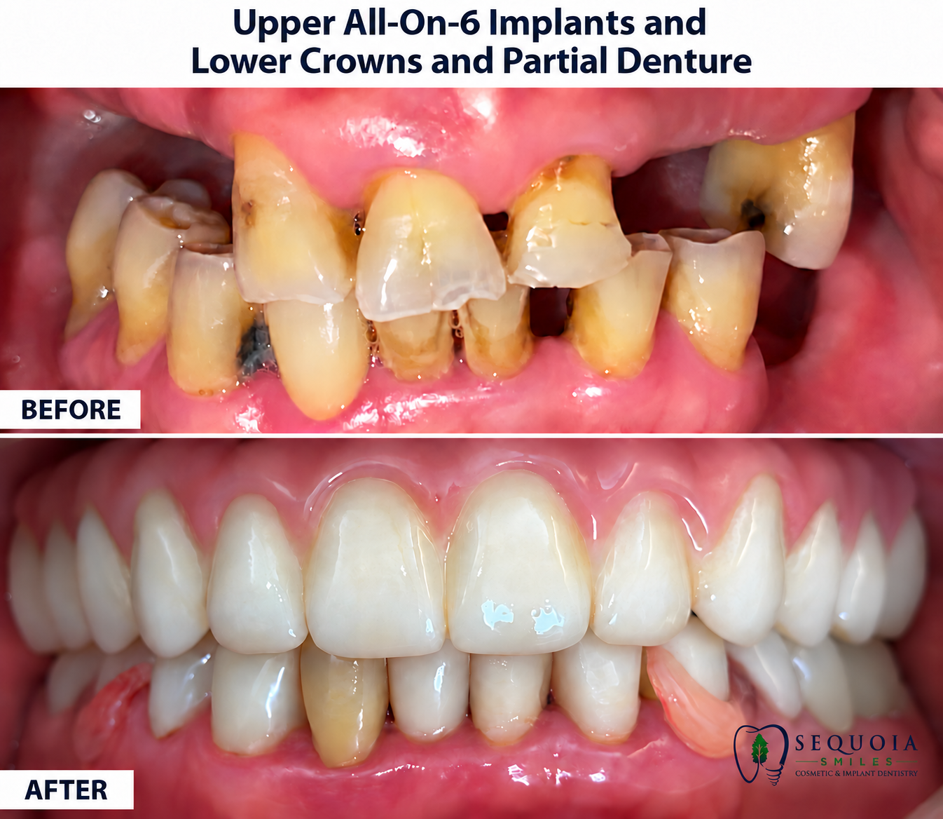 Before and after All-on-6 dental implant results