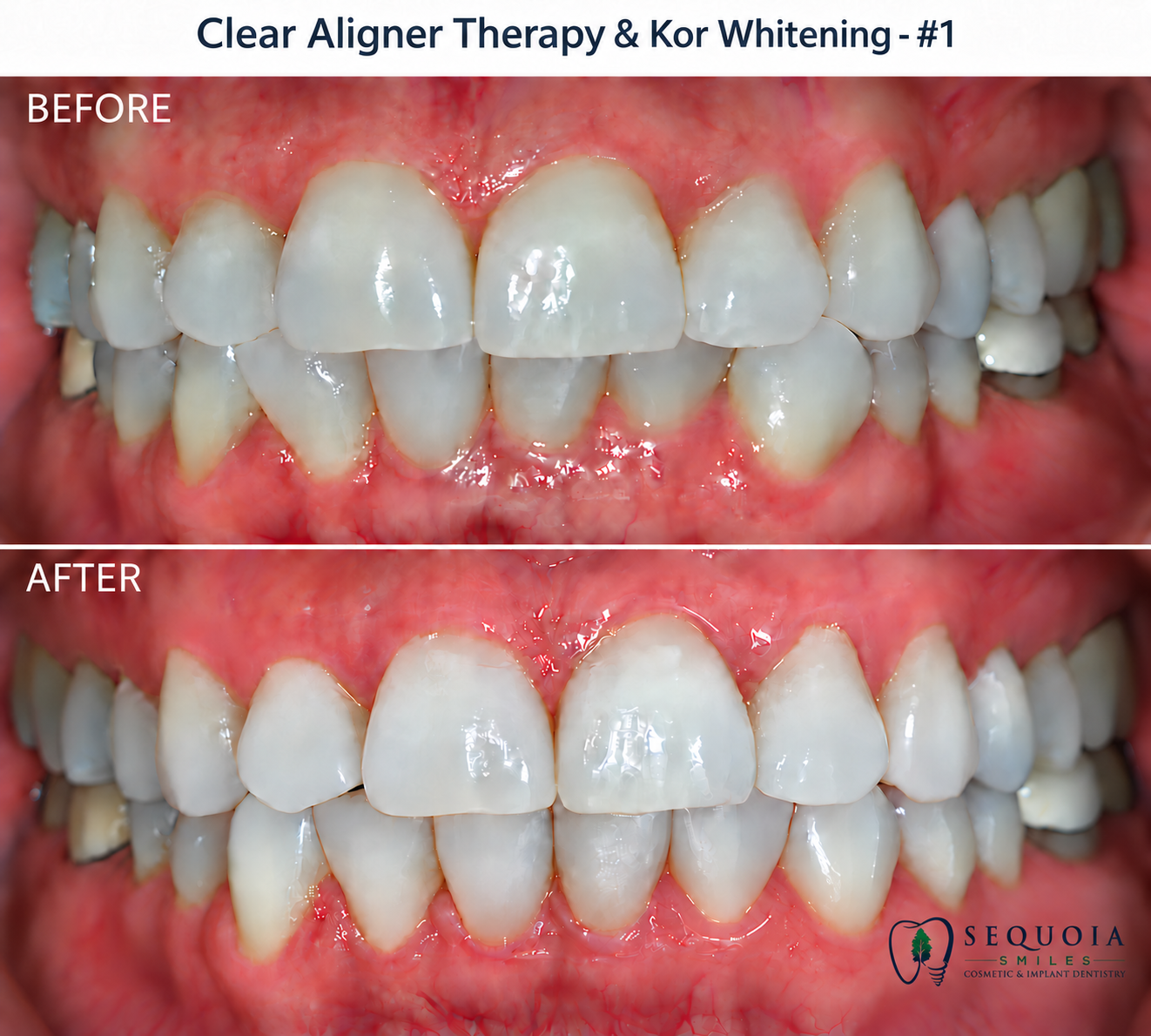Before and after clear aligner treatment and Kor whitening results