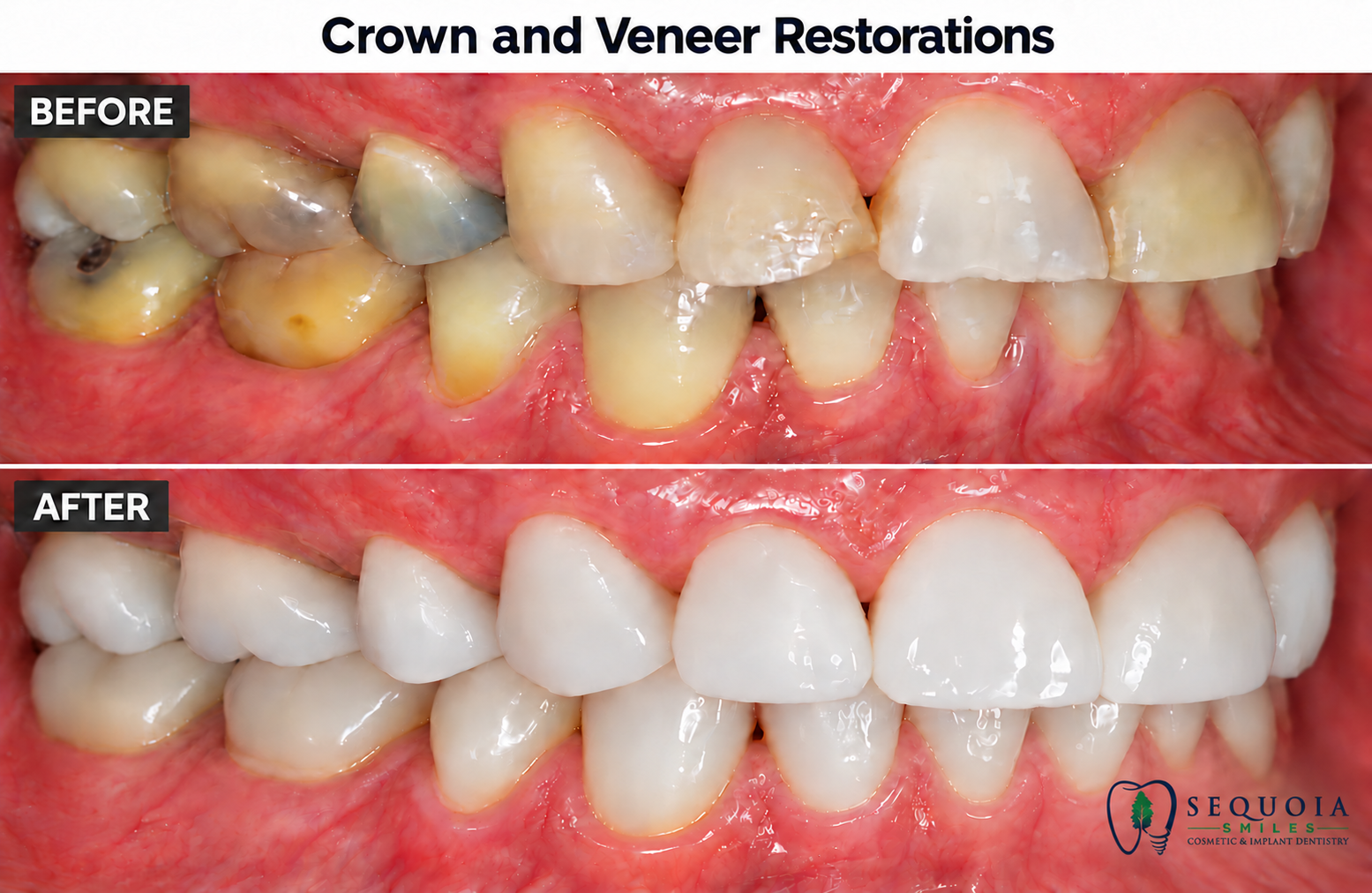 Before and after dental crown and veneer results