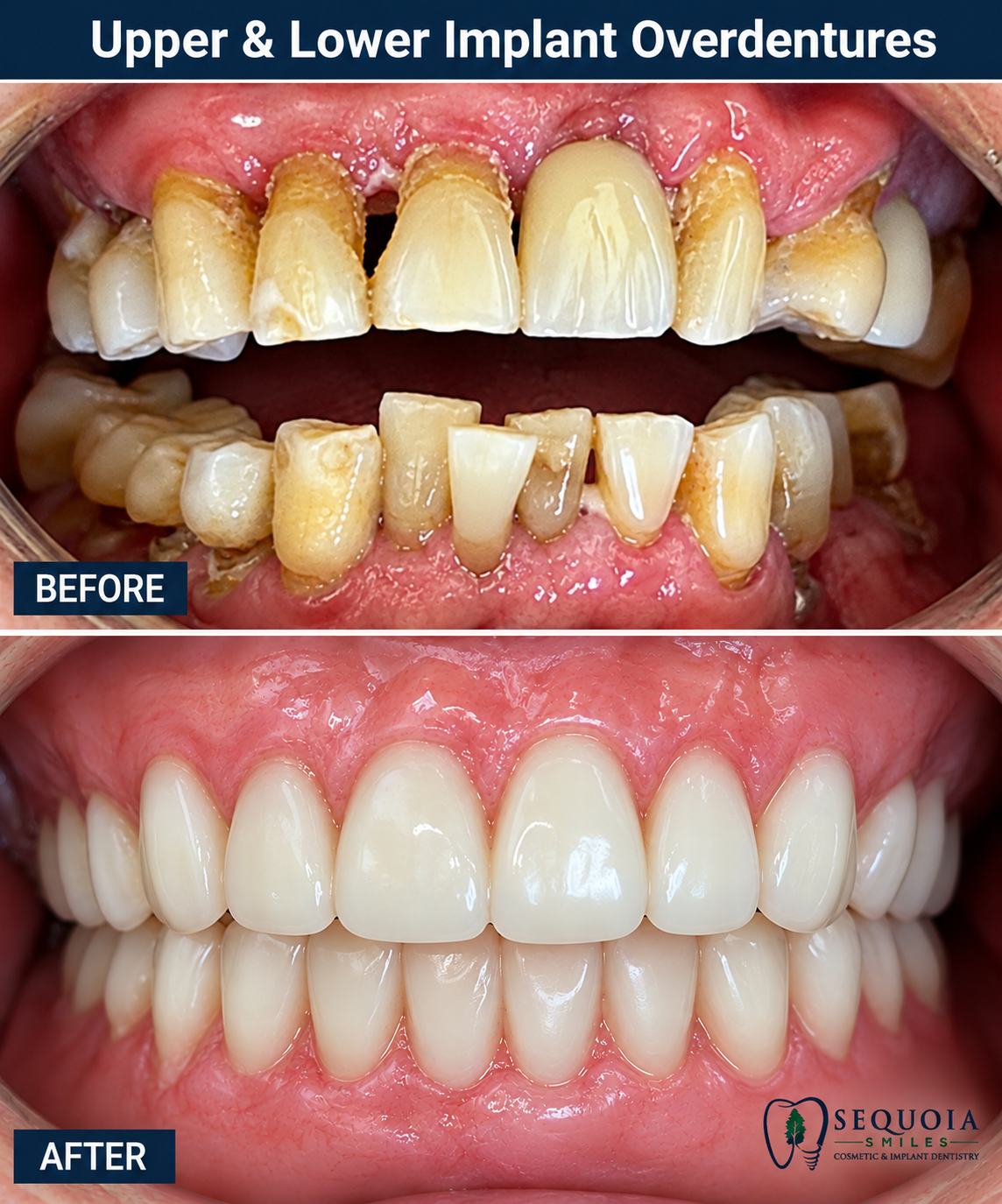Before and after overdenture results