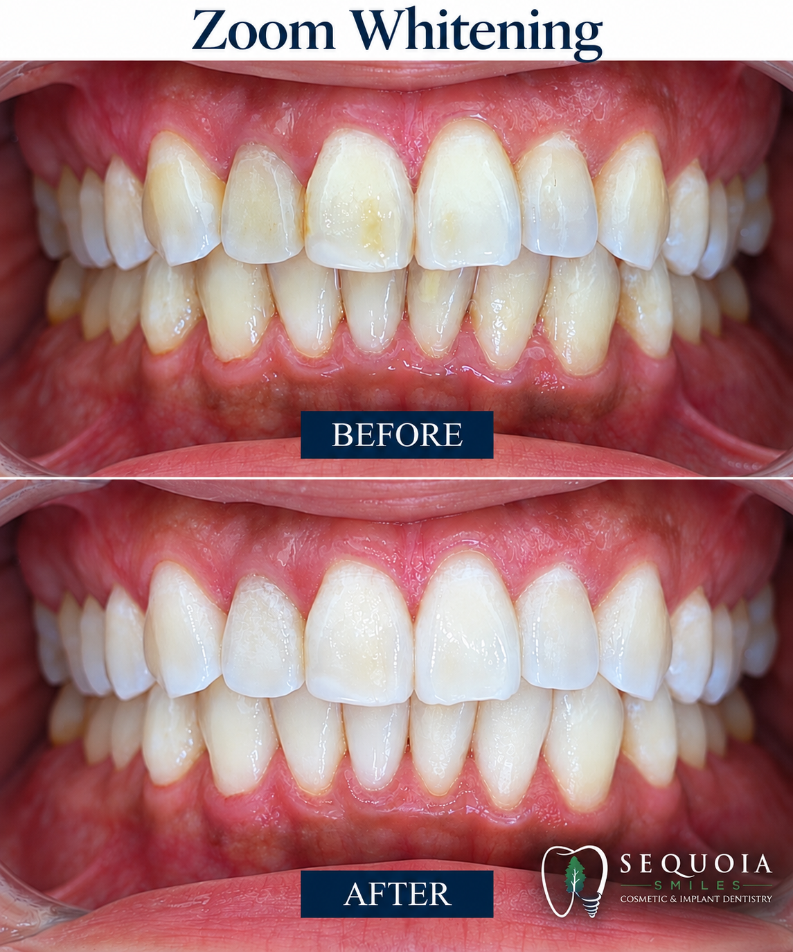 Before and after Zoom teeth whitening results
